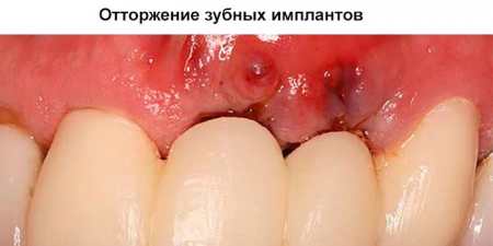 Гінгівіт гострий і хронічний — як лікувати в домашніх умовах