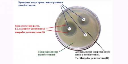 Баланопостит гострий і хронічний — як лікувати в домашніх умовах