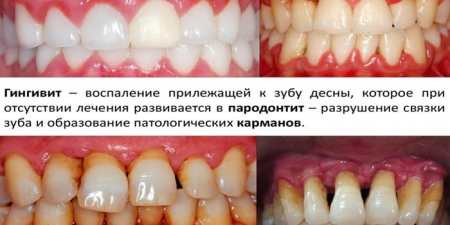 Гінгівіт гострий і хронічний — як лікувати в домашніх умовах