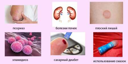 Баланопостит гострий і хронічний — як лікувати в домашніх умовах