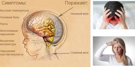 Менінгоенцефаліт – що це таке, шляхи зараження, клінічна картина, способи терапії