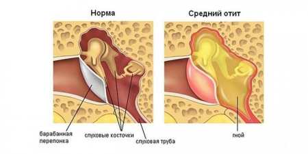 Перша допомога при болю у вусі — використання знеболюючих препаратів