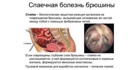 Вправи при спайках кишечника — огляд популярних методик з описом