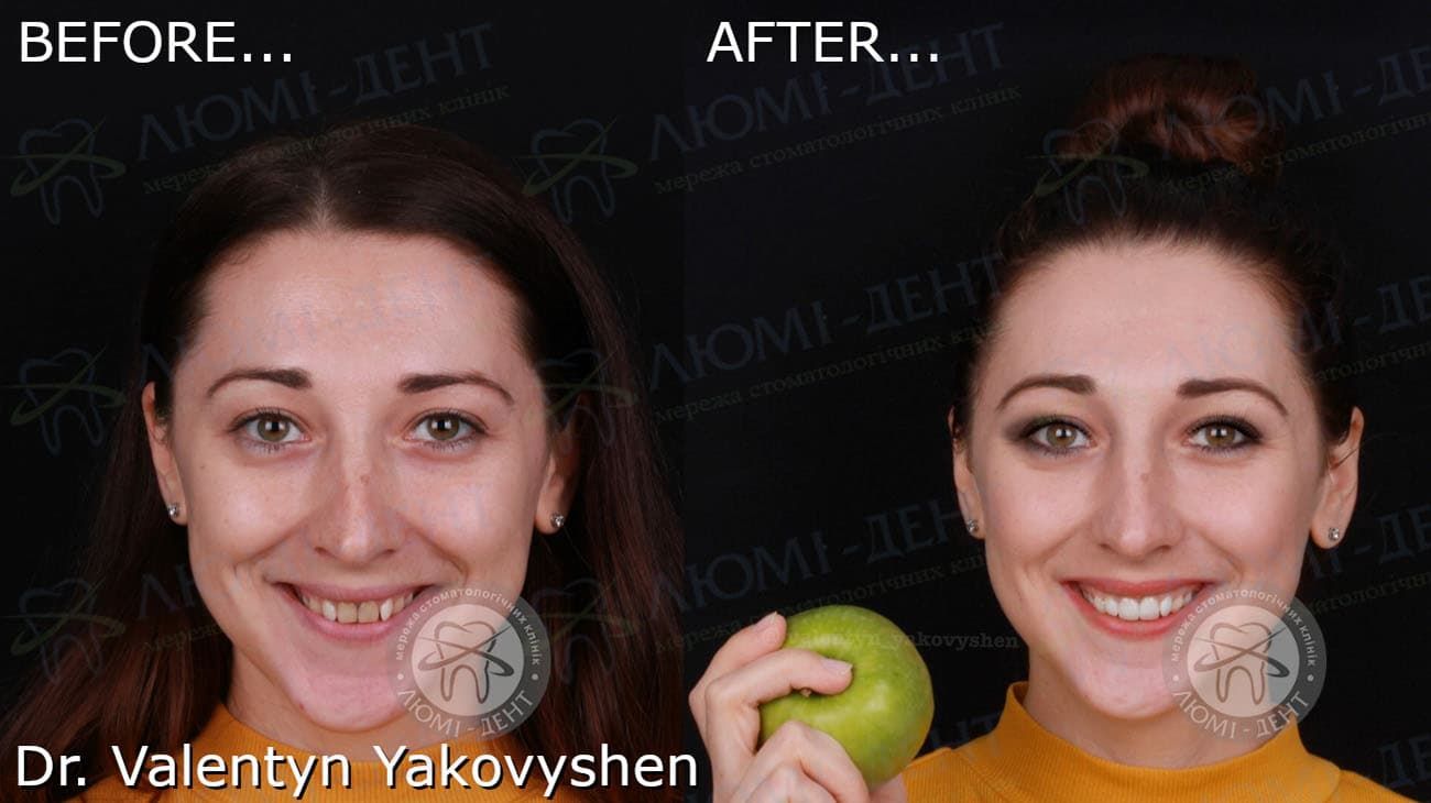Чи варто встановлювати вініри
