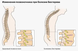 болезнь Бехтерева
